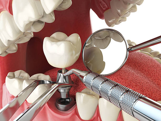 Best Emergency Root Canal Treatment in Fort Pierce South, FL